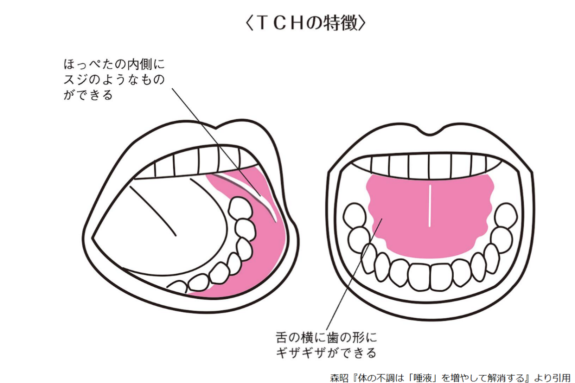 頬 の 内側 噛む