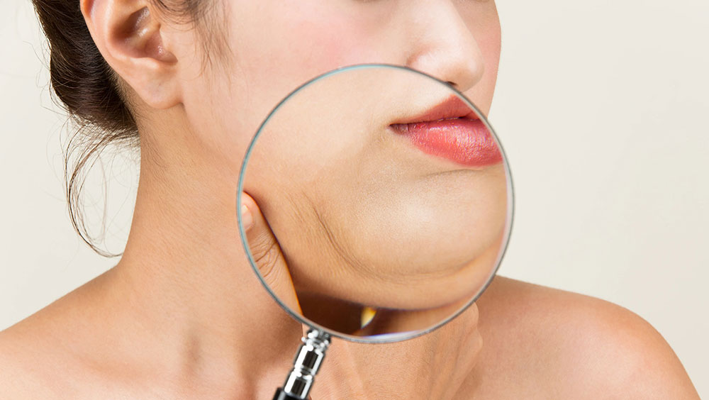 気になる二重顎、ほうれい線に「デンタスリム（脂肪溶解注射）」