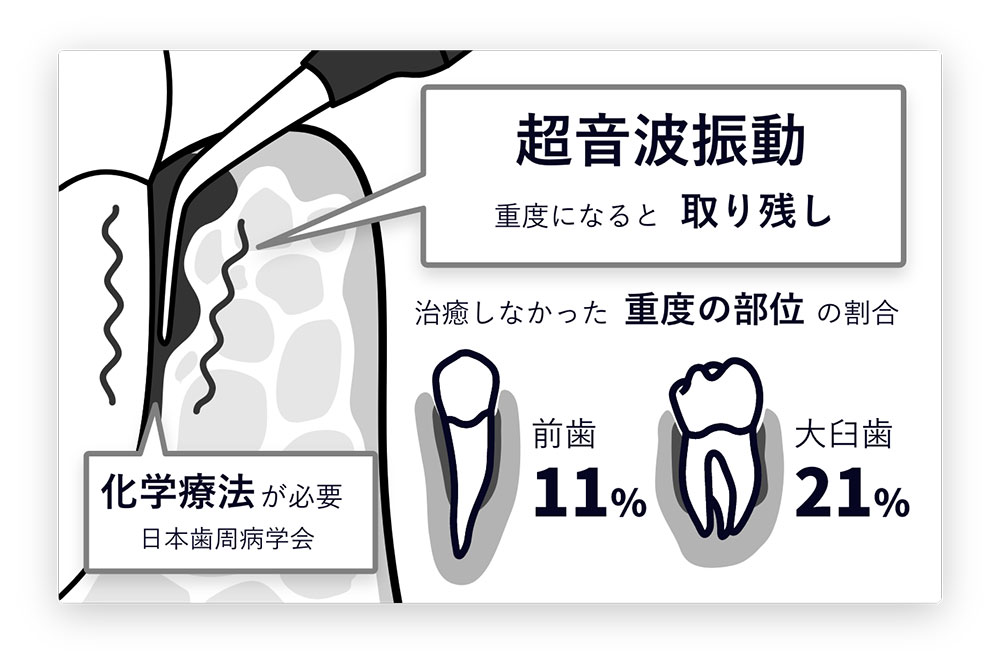 超音波振動のみ