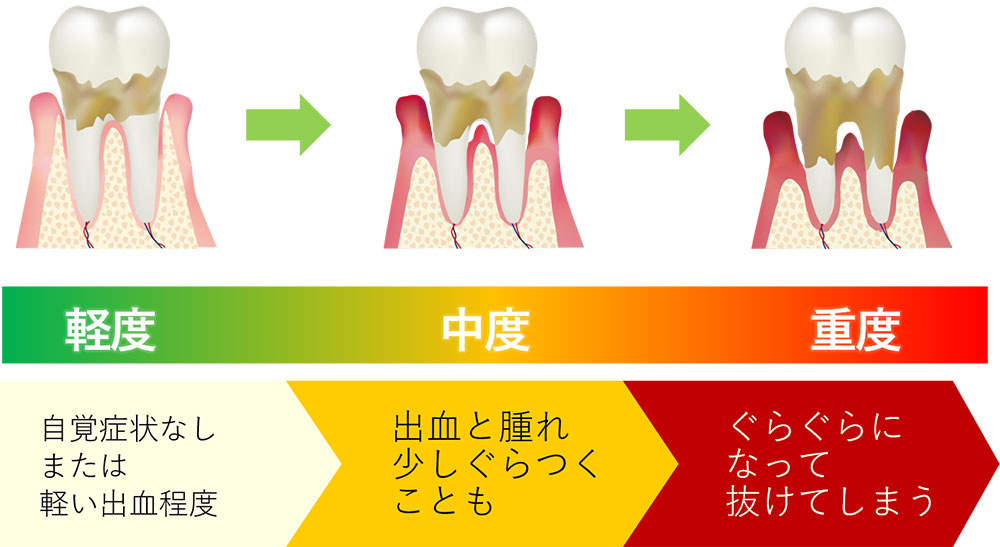 歯周病の悪化