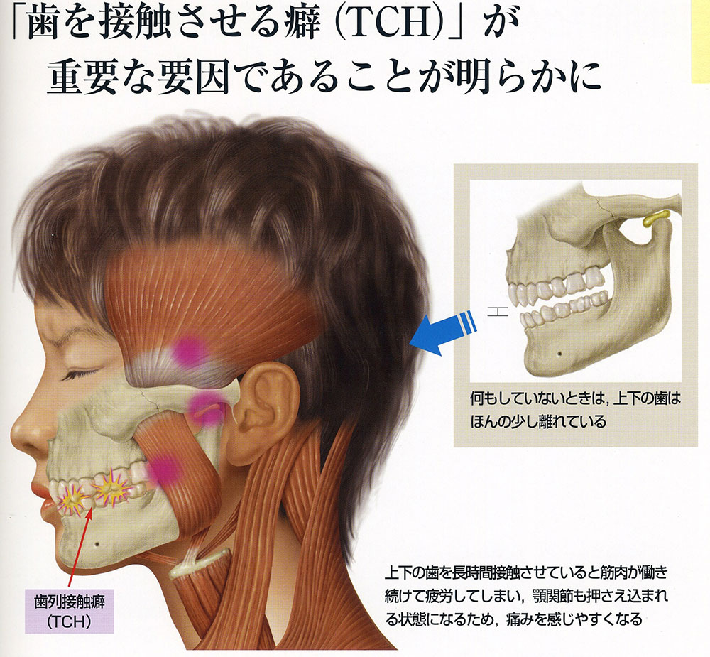 歯を接触させる癖（THC）が重要な要因であることが明らかに