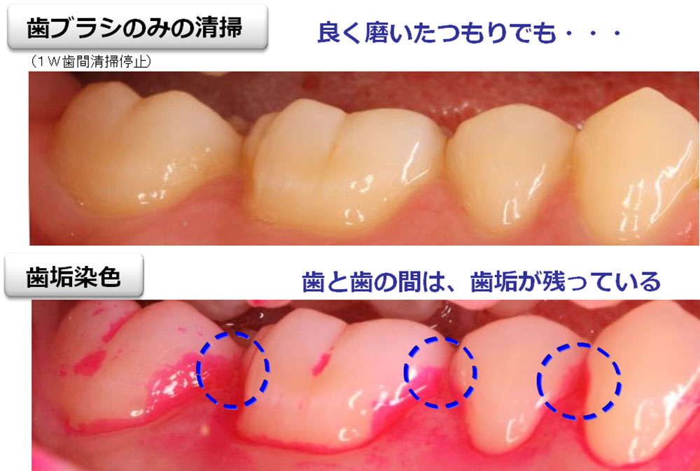 歯ブラシのみの清掃はよく磨いたつもりでも歯と歯の間は、歯垢が残っている
