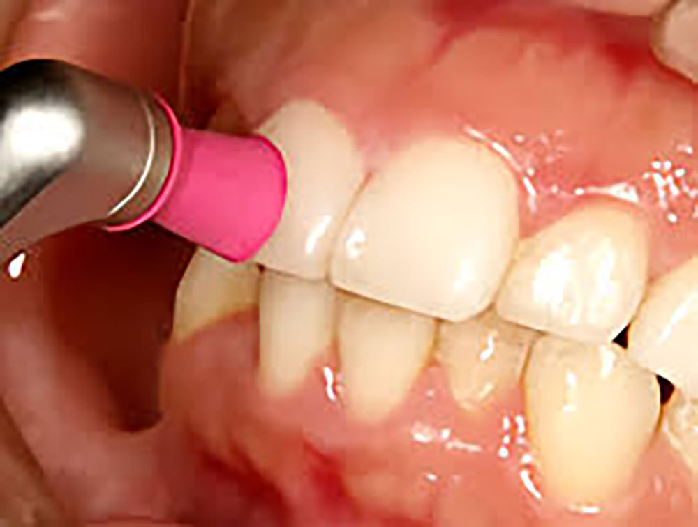 歯科医院でプロが行う歯のクリーニングPMTC