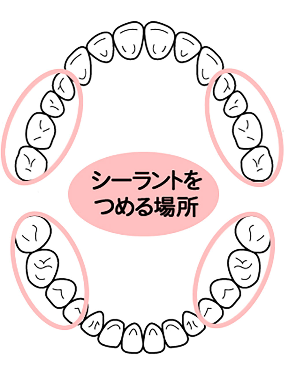 シーラントをつめる場所