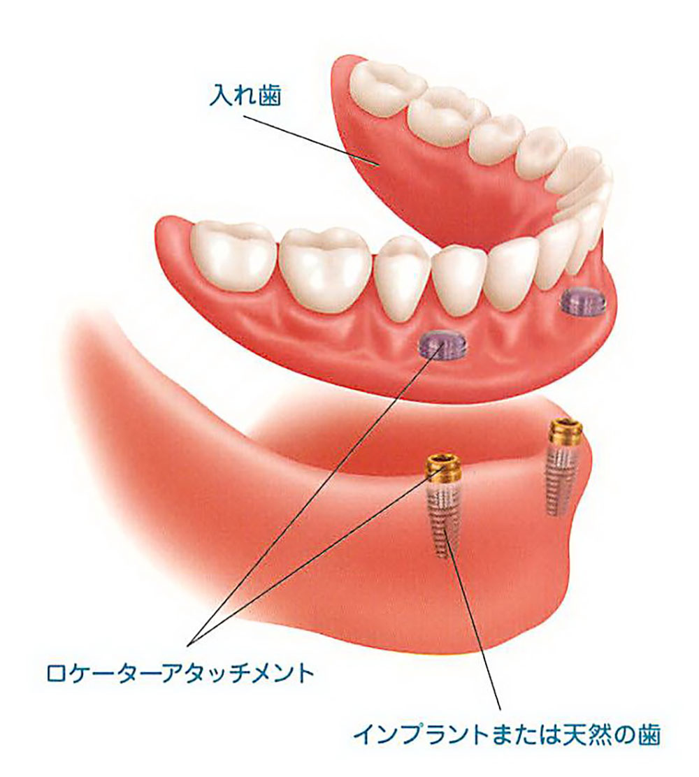 ロケーター義歯とは？