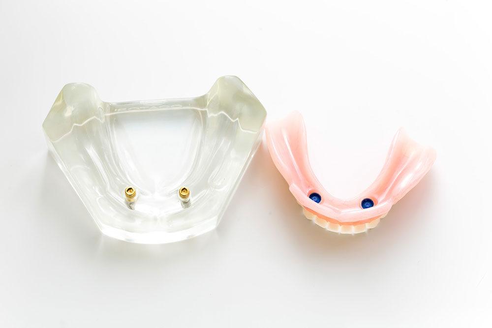 ロケーター義歯とは、数本のインプラントで入れ歯を支える最新の入れ歯治療です。