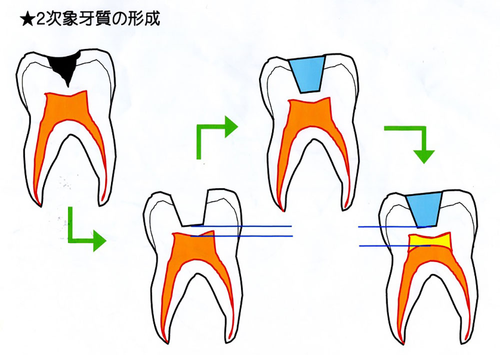 虫歯の治療後に歯が痛い、しみるのは、なぜ？