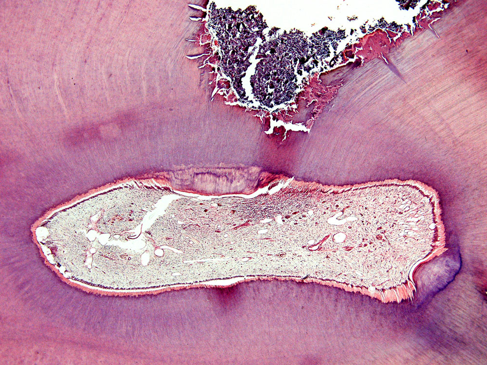 第二象牙質ができるまで待ちましょう！