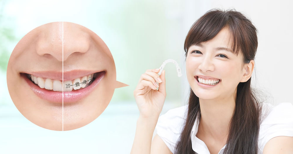 マウスピース矯正治療について