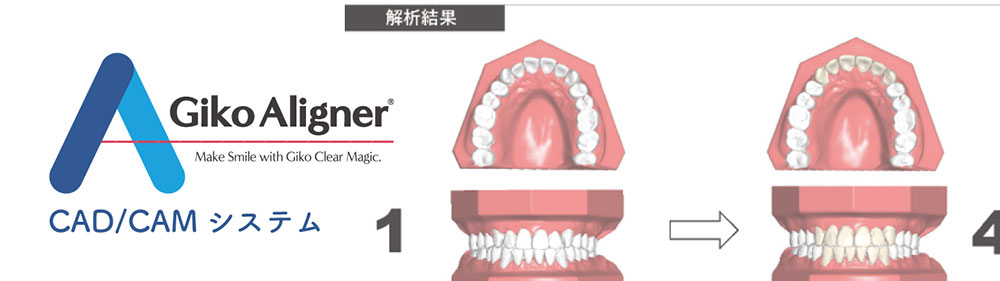 GikoAligner® について