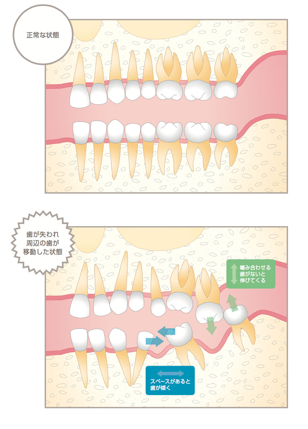 正常な状態と歯が失われ周辺の歯が移動した状態