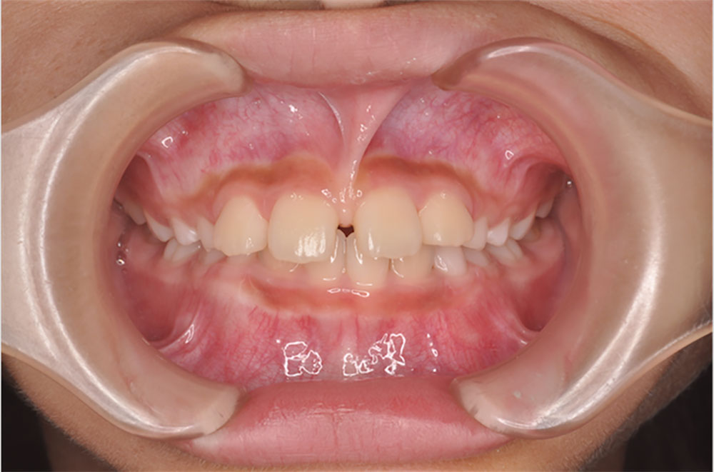 上唇小帯について