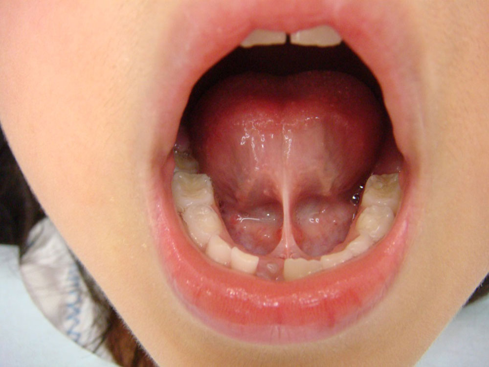 舌小帯について