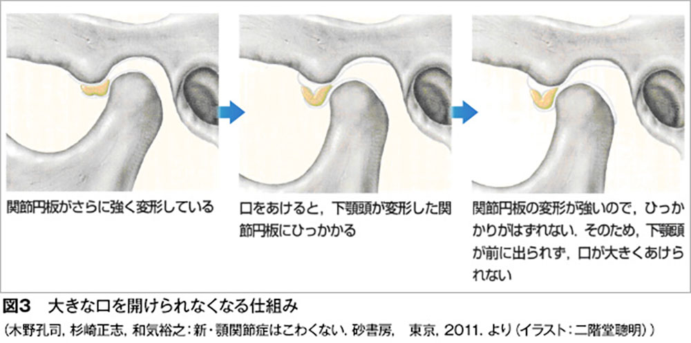 大きな口が開けられなくなる状態です（図3）