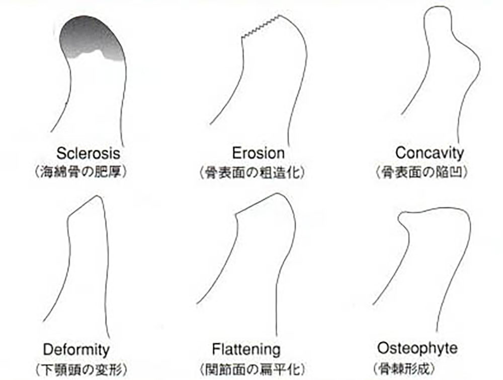 関節を作っている骨が変形するタイプの変形性顎関節症（図5）