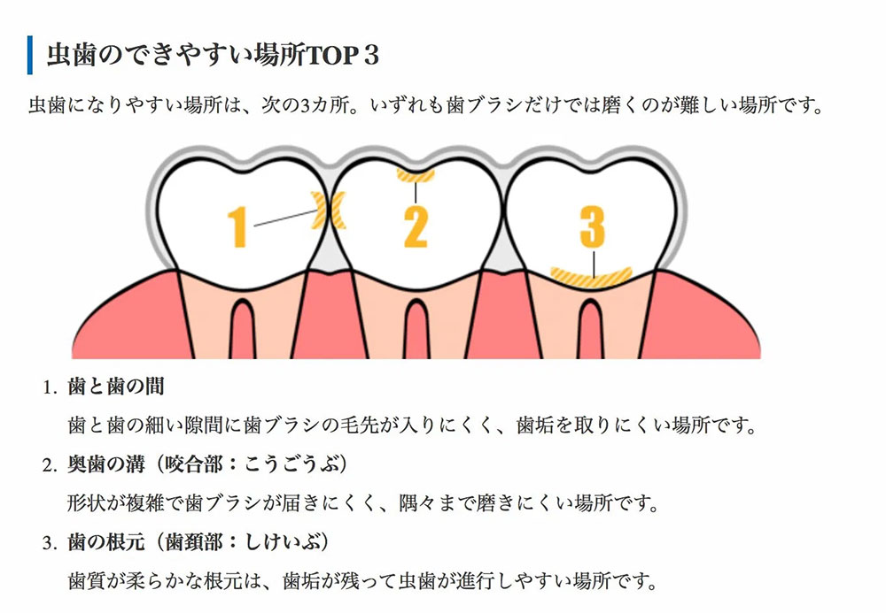 虫歯のできやすい場所TOP3