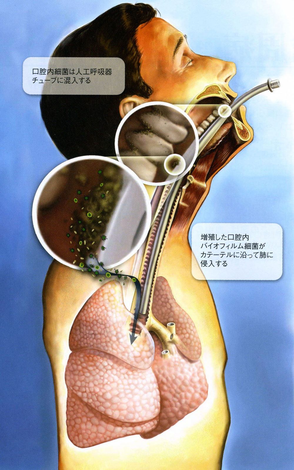 緊急時のVAP（人工呼吸器関連肺炎）の発症を予防