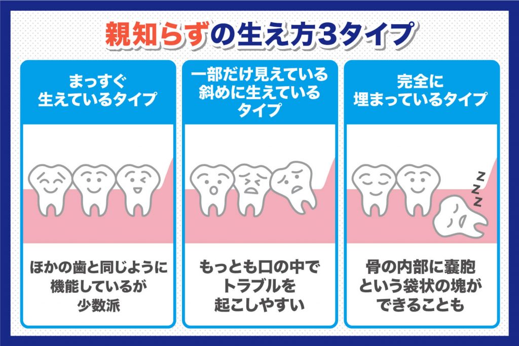 親知らずの生え方の3パターン