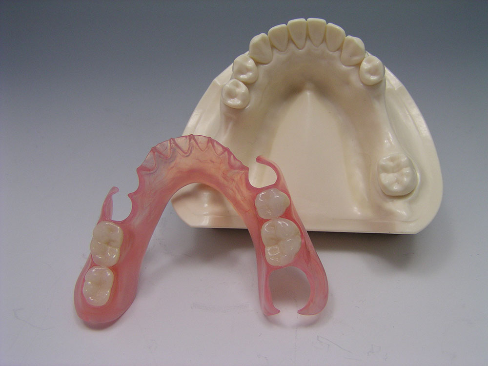 ノンクラスプデンチャー