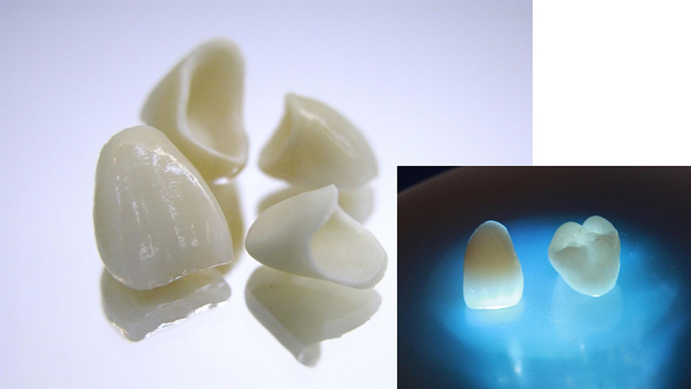 オールセラミッククラウン