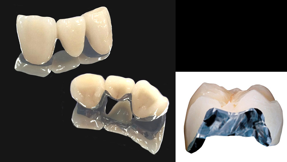 メタルセラミッククラウン
