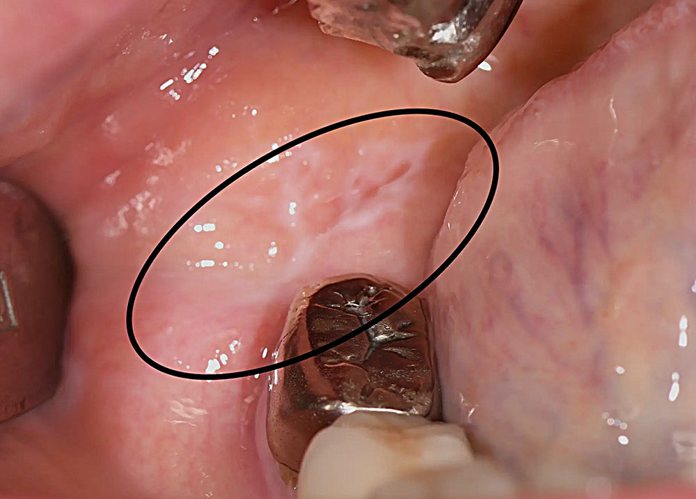 歯科金属アレルギーの症状