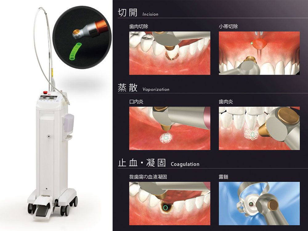 炭酸ガス(CO2)レーザー
