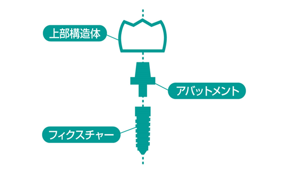 インプラントの構造について