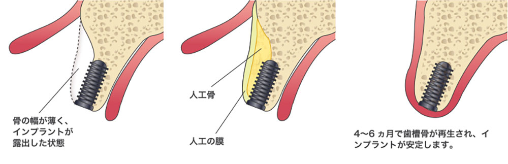 GBR法（骨再生誘導法）