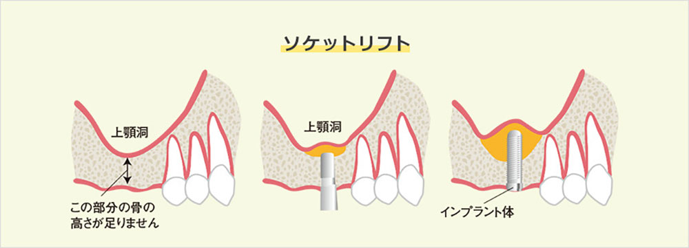 サイナスリフト