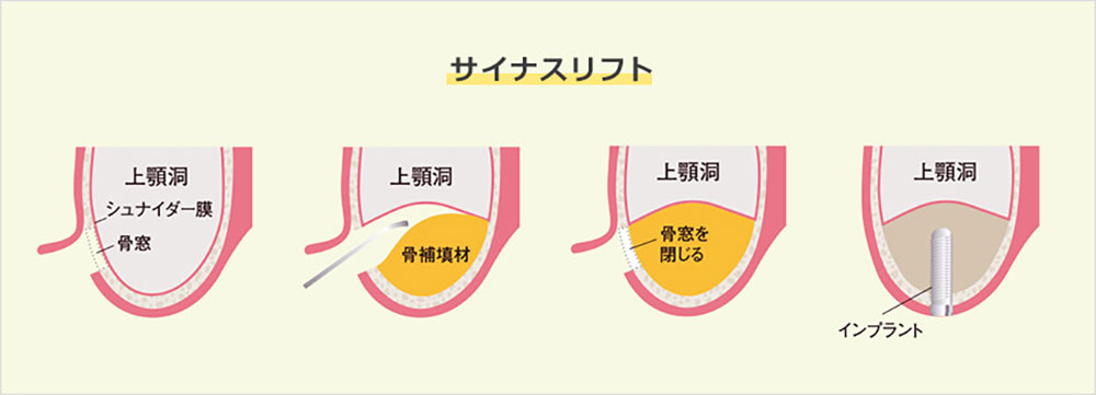 ソケットリフト
