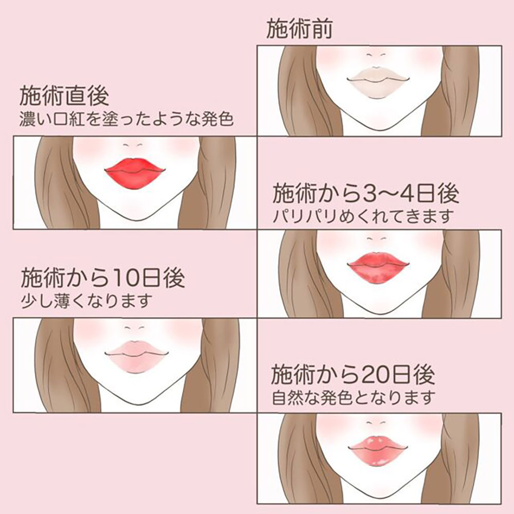 リップアート後のダウンタイム