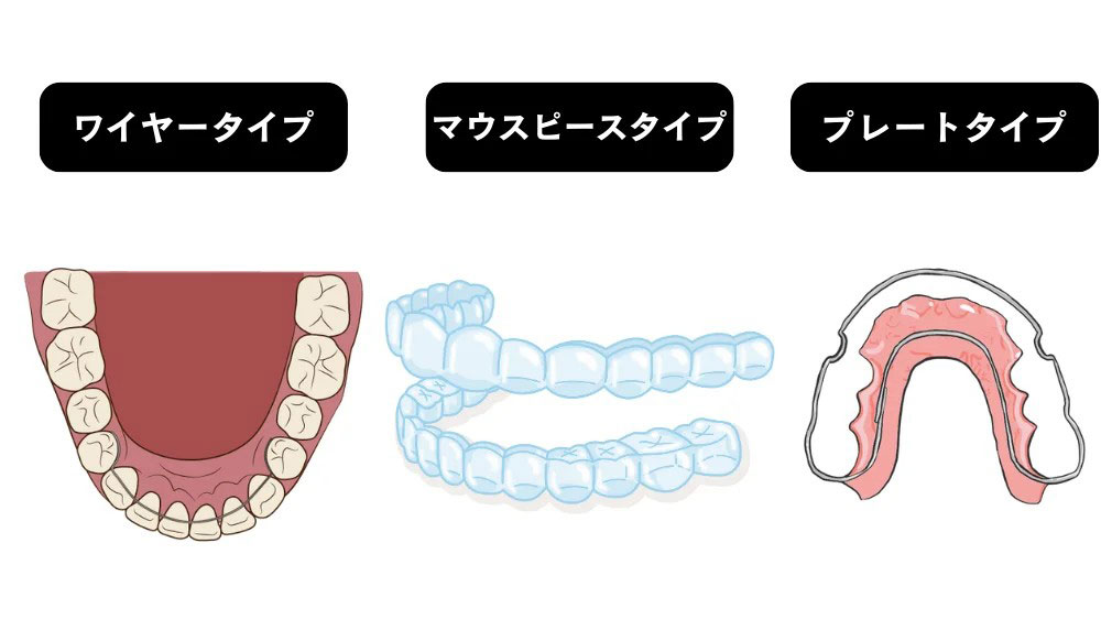 選べる3つの保定装置（リテーナー）ワイヤータイプ マウスピースタイプ プレートタイプ