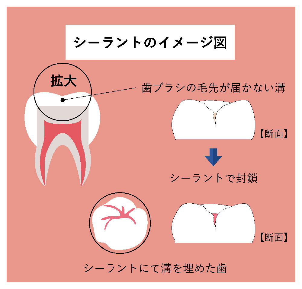 虫歯の予防②シーラント