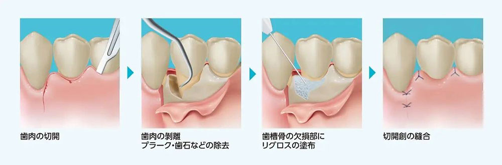歯周組織再生療法