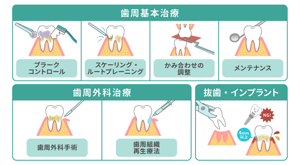 歯周病の治療方法