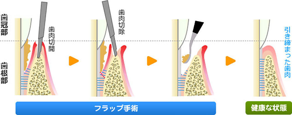 フラップ手術（歯肉剥離掻爬術）