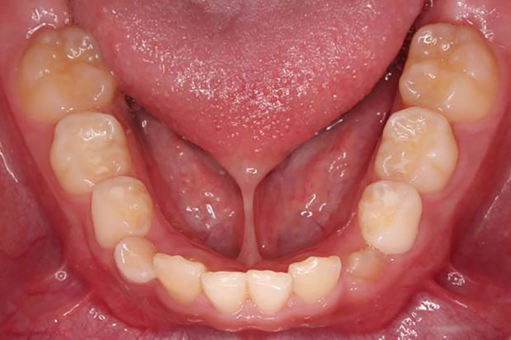 上唇小帯・舌小帯付着異常