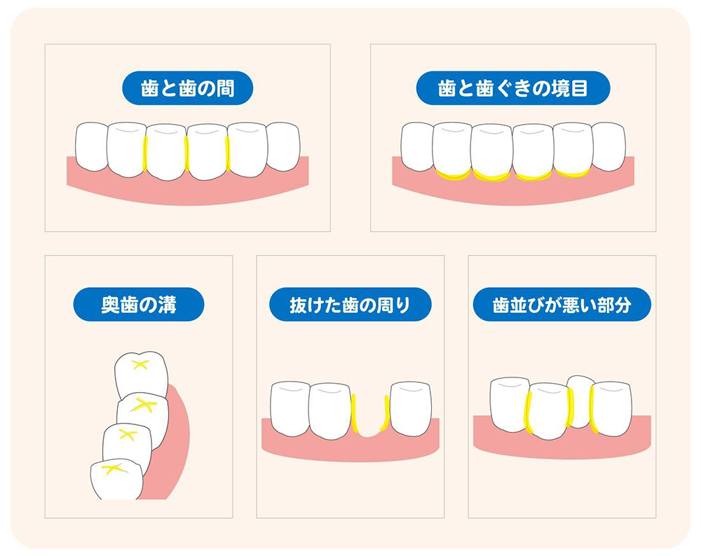 虫歯ができやすい場所