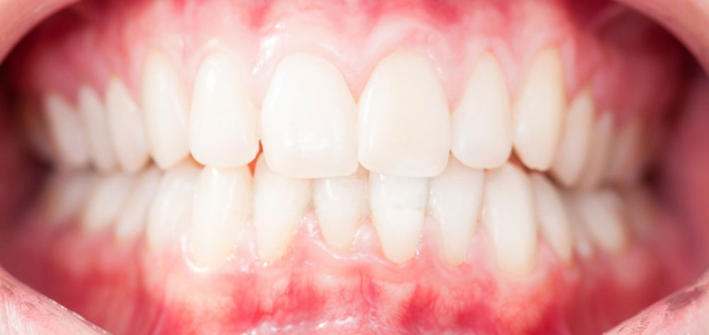 ガムピーリング