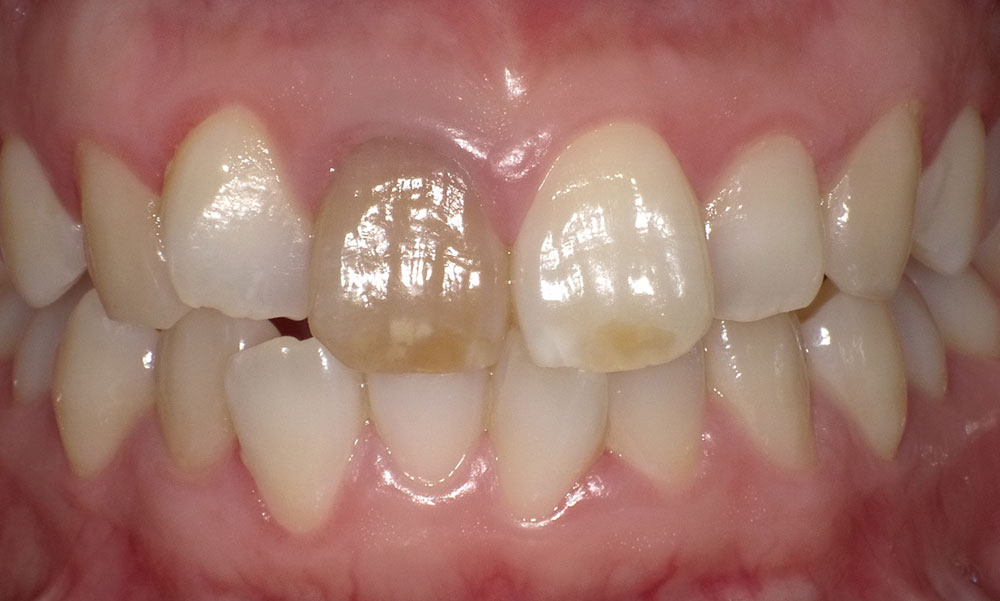 ウォーキングブリーチ