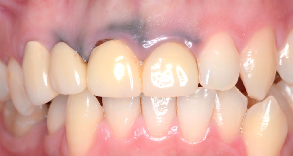 レーザーによる歯肉のメタルタトゥー除去